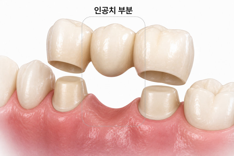 평택비전동치과 앞니 브릿지 충치, 전체 제거가 필요한 이유 관련 사진 9