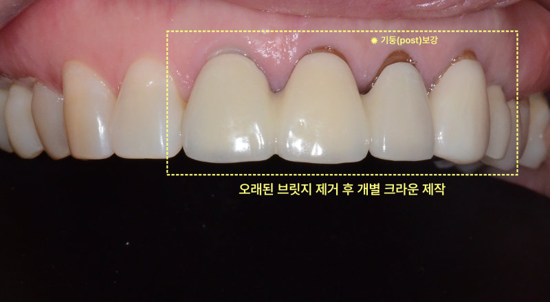 오래된 브릿지 제거 후 기둥(post) 보강 및 개별 크라운 제작 전 상악 전치부 구강 사진