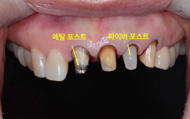 메탈포스트와 파이버포스트가 삽입된 상악 전치부 치아의 구강 사진