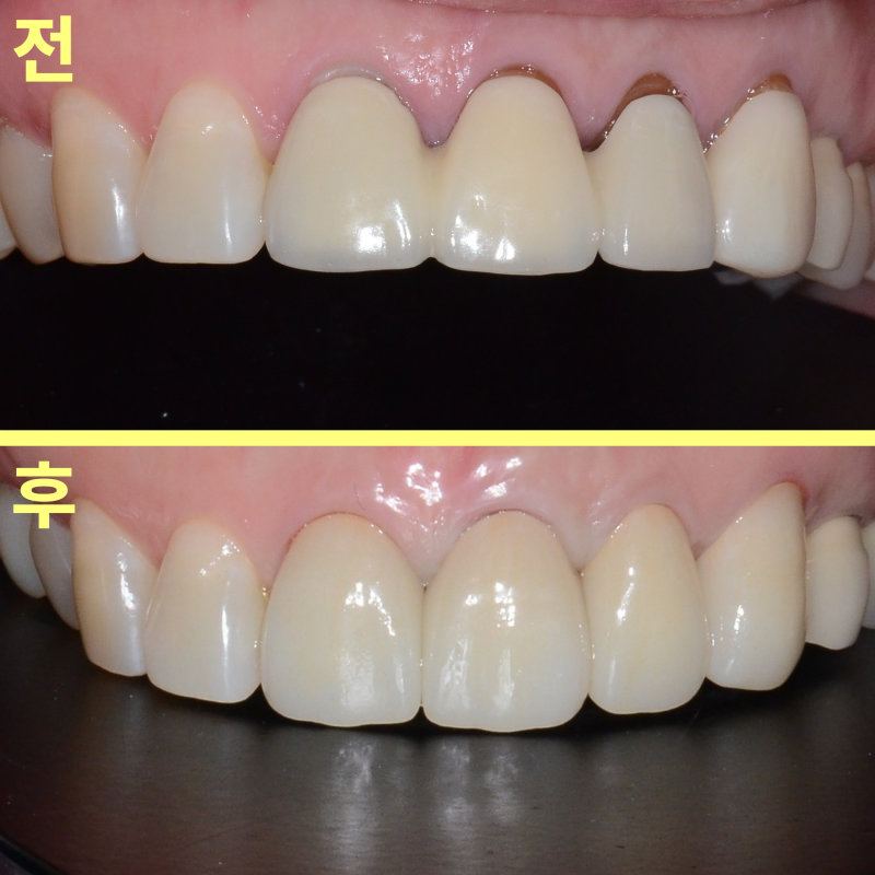 오래된 브릿지 보철물 장착 전(위)과 개별 크라운 제작 후(아래) 상악 전치부 구강 전면 비교 사진