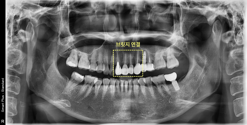 파노라마 방사선 사진에 브릿지 연결 부위가 노란색 점선 사각형으로 표시되어 있음