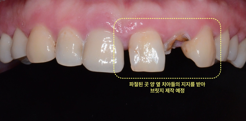 파절된 앞니 양 옆 치아를 지지받아 브릿지 제작 예정임을 나타내는 구강 내 정면 사진