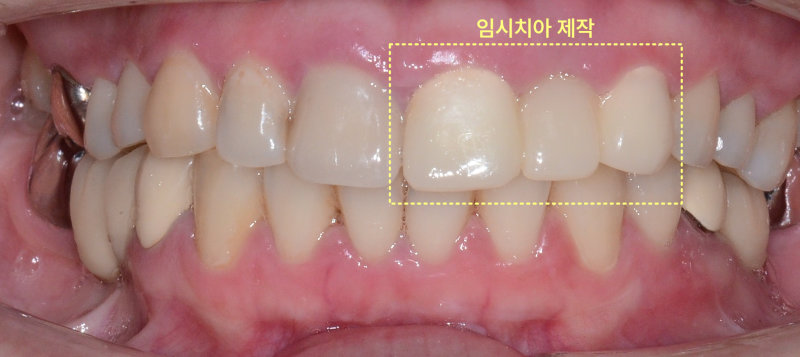 임시치아 제작 후 구강 내 정면 사진