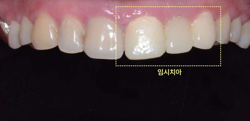 임시치아가 노란 점선으로 표시된 구강 내 정면 사진