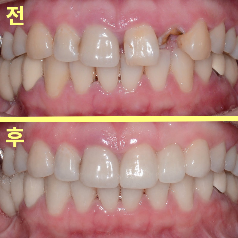 브릿지 치료 전후 구강 내 정면 비교 사진