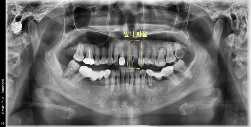 앞니 파절 부위가 노란 점선으로 표시된 파노라마 방사선 사진