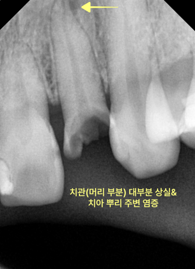앞니 치관 대부분 상실 및 치아 뿌리 주변 염증을 나타내는 치근단 방사선 사진