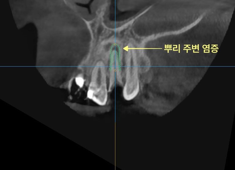 앞니 뿌리 주변 염증 부위가 노란색 화살표로 표시된 CT 사진