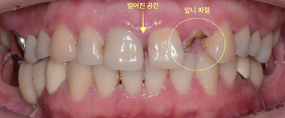 벌어진 공간과 앞니 파절이 노란 점선으로 표시된 구강 내 정면 사진