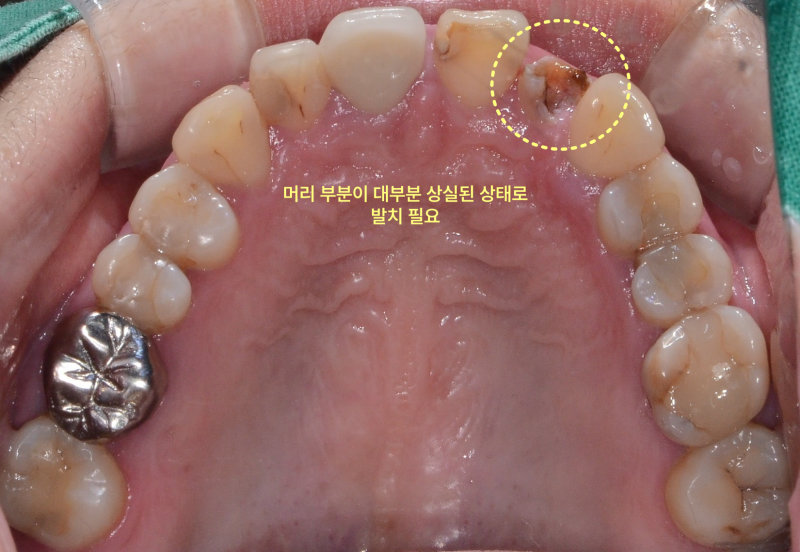 머리 부분이 대부분 상실되어 발치가 필요한 앞니를 보여주는 구강 내 상악면 사진