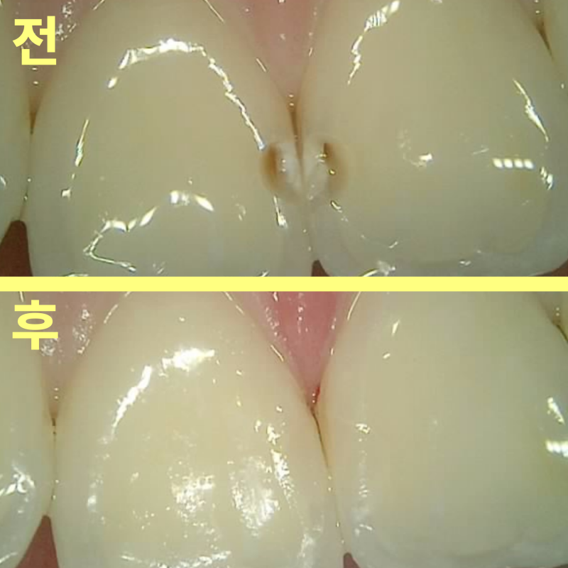 용이동치과 앞니 충치 치료, 티 나지 않게 가능한가요? 관련 사진 10