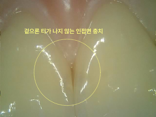 용이동치과 앞니 충치 치료, 티 나지 않게 가능한가요? 관련 사진 2