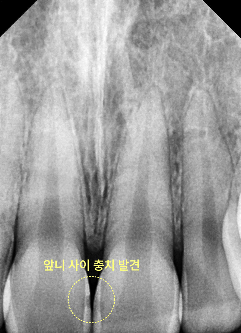 용이동치과 앞니 충치 치료, 티 나지 않게 가능한가요? 관련 사진 3
