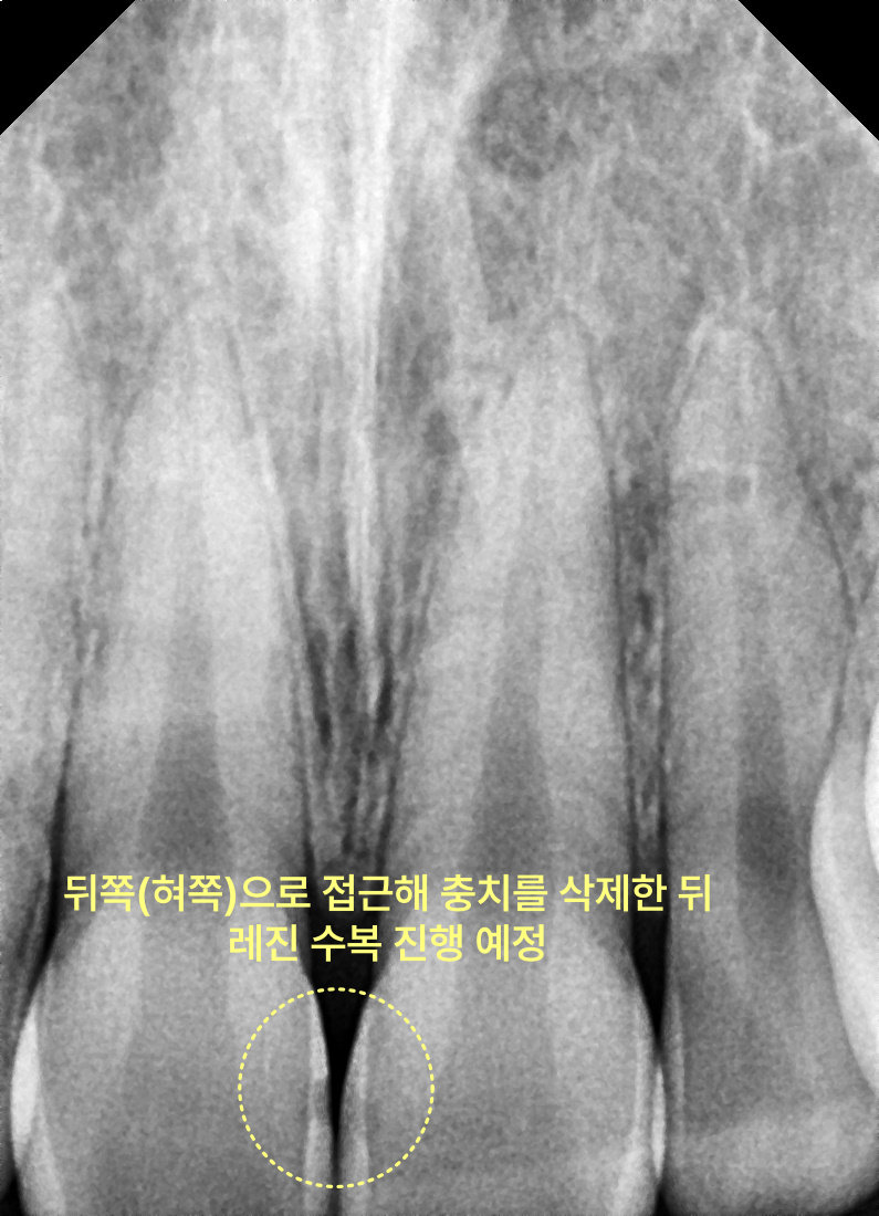용이동치과 앞니 충치 치료, 티 나지 않게 가능한가요? 관련 사진 5