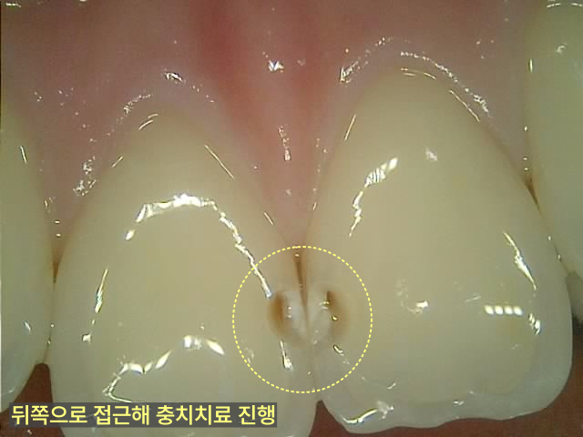 용이동치과 앞니 충치 치료, 티 나지 않게 가능한가요? 관련 사진 6