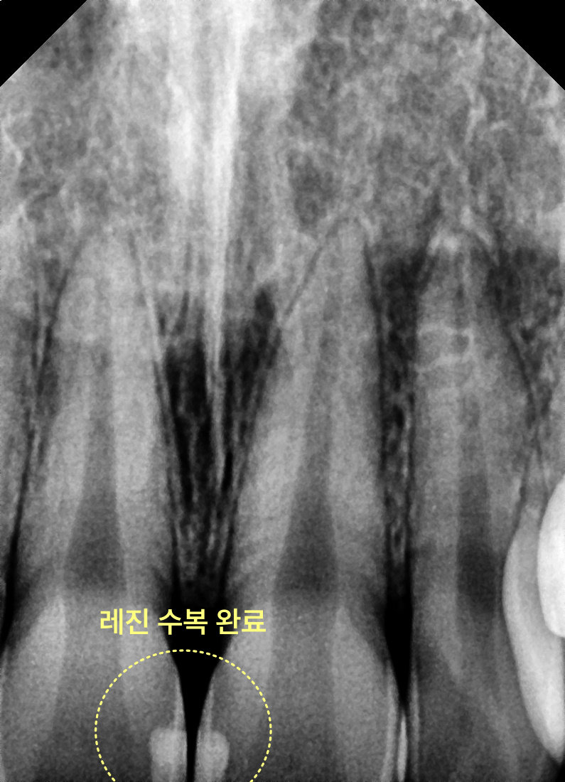 용이동치과 앞니 충치 치료, 티 나지 않게 가능한가요? 관련 사진 9