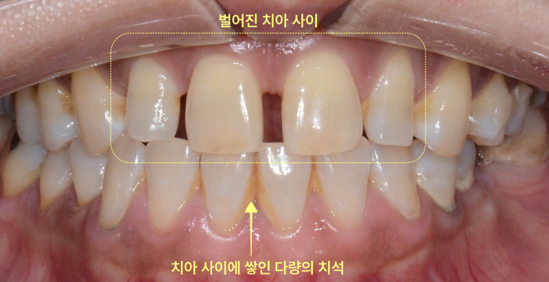 동삭동치과 어금니 빠지면 앞니가 벌어지나요? 관련 사진 5