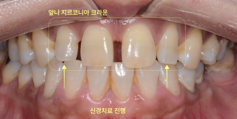 동삭동치과 어금니 빠지면 앞니가 벌어지나요? 관련 사진 9