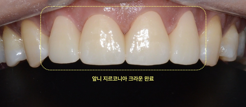 동삭동치과 어금니 상실 뒤 앞니가 벌어진 까닭 관련 사진 20