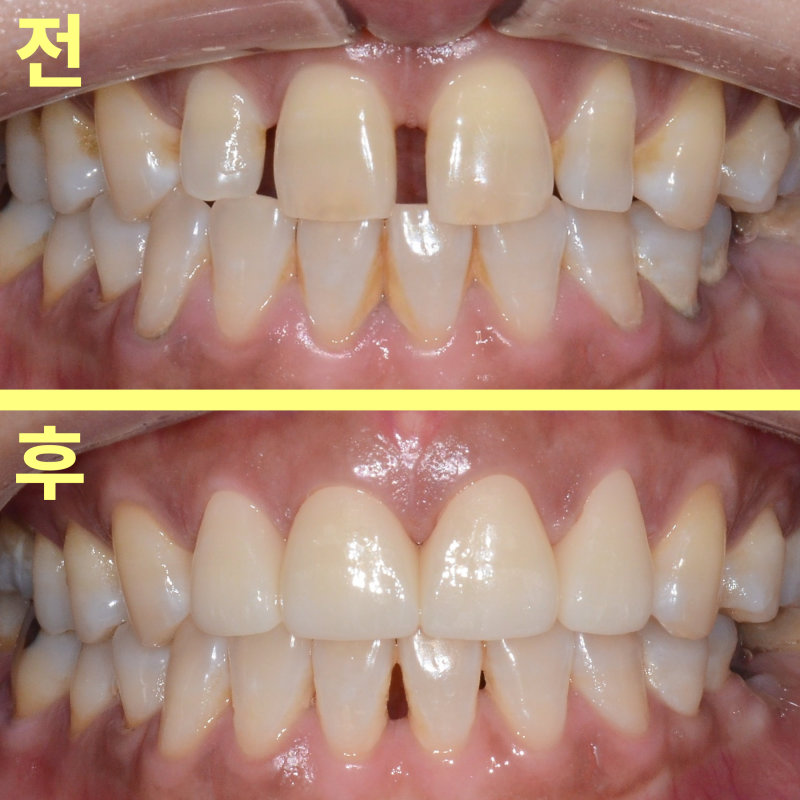 동삭동치과 어금니 상실 뒤 앞니가 벌어진 까닭 관련 사진 21
