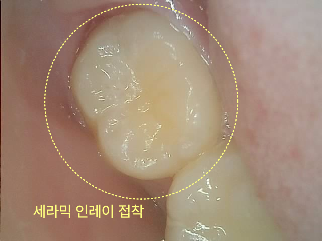 세라믹 인레이가 접착된 치아의 측면 모습