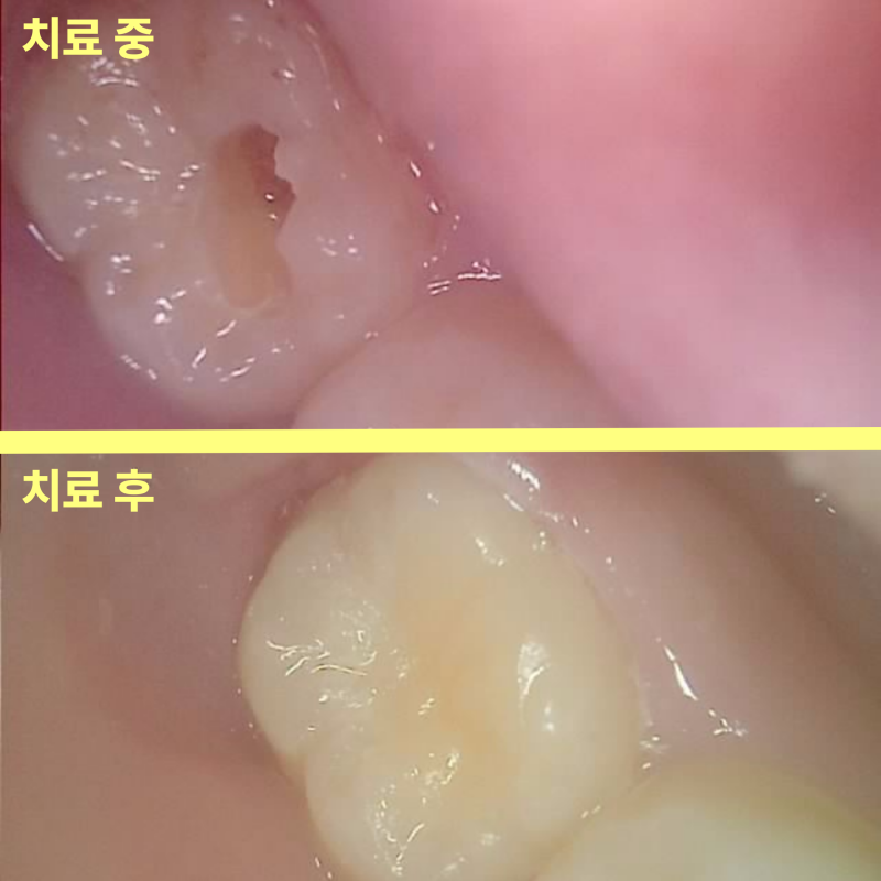 깊은 충치 치료 전후 치아의 모습 비교 사진
