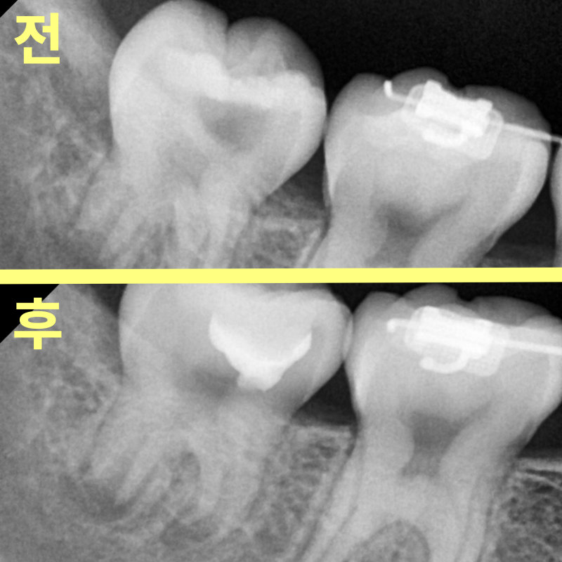 깊은 충치 치료 전후 치아의 치근단 방사선 사진 비교