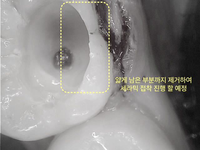 충치 제거 후 치아 내부의 얇게 남은 부분을 보여주는 확대 사진