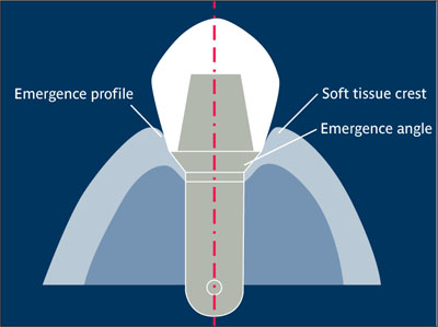 임플란트 보철물의 Emergence profile과 Emergence angle을 설명하는 다이어그램