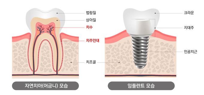 자연치아와 임플란트 치아의 구조를 비교한 설명 이미지