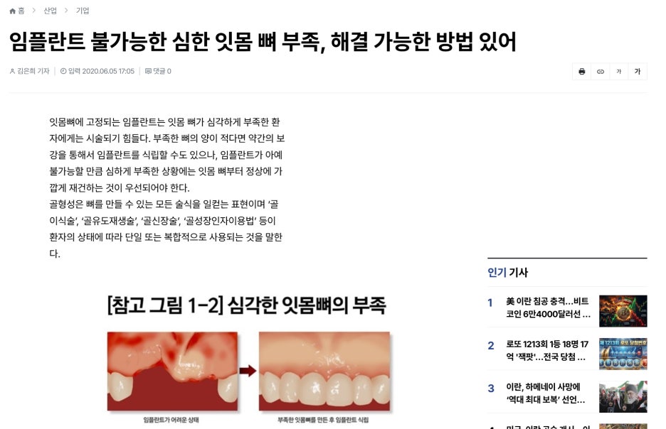 임플란트 불가능한 심한 잇몸뼈 부족 해결 방법 기사 이미지