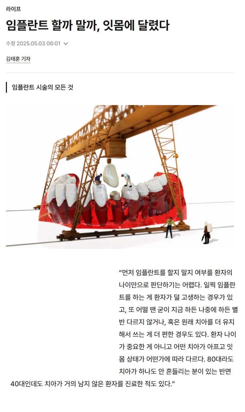 임플란트 시술의 모든 것 기사 이미지