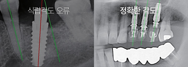 임플란트 식립 각도 오류와 정확한 각도를 비교한 방사선 사진