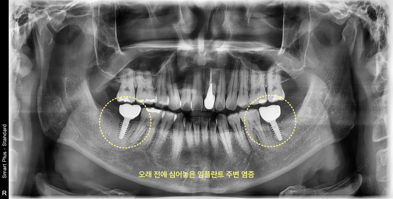 하악 좌우측 어금니 임플란트 주위 골소실이 보이는 파노라마 방사선 사진