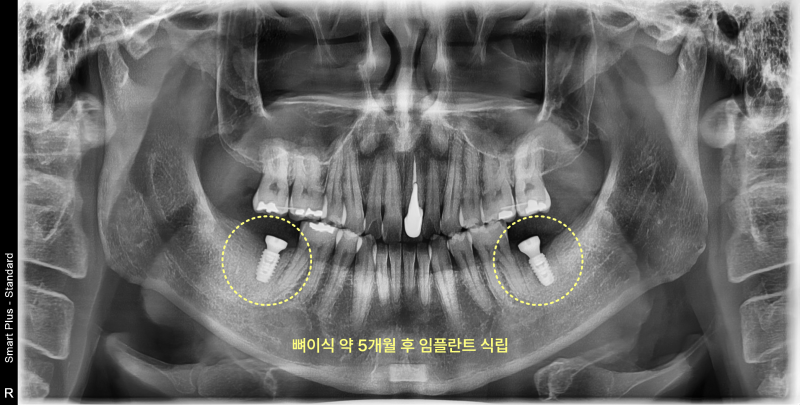 하악 좌우측 어금니 뼈이식 5개월 후 임플란트 식립된 파노라마 방사선 사진