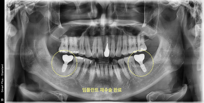 공도치과 임플란트 두 번 실패해도 다시 성공할 수 있나요? 관련 사진 22