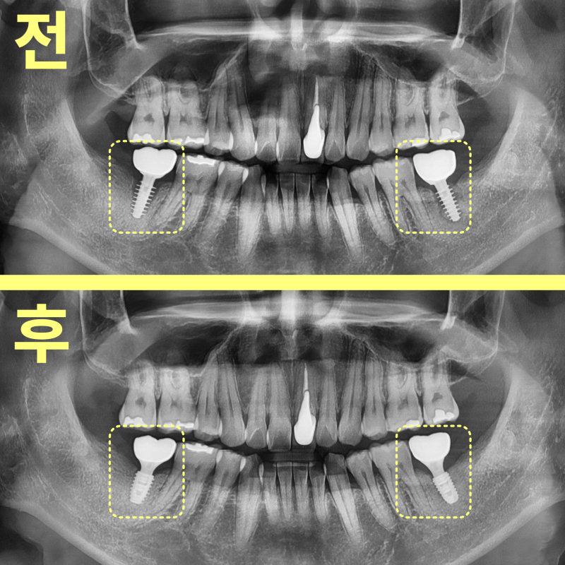 공도치과 임플란트 두 번 실패해도 다시 성공할 수 있나요? 관련 사진 23