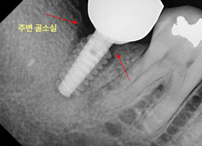 하악 좌측 어금니 임플란트 주위 골소실을 보여주는 치근단 방사선 사진