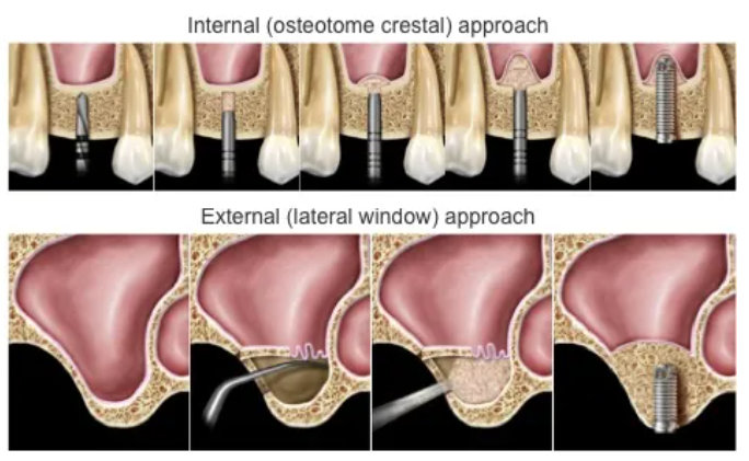 상악동 거상술의 Internal (osteotome crestal) approach와 External (lateral window) approach 그림