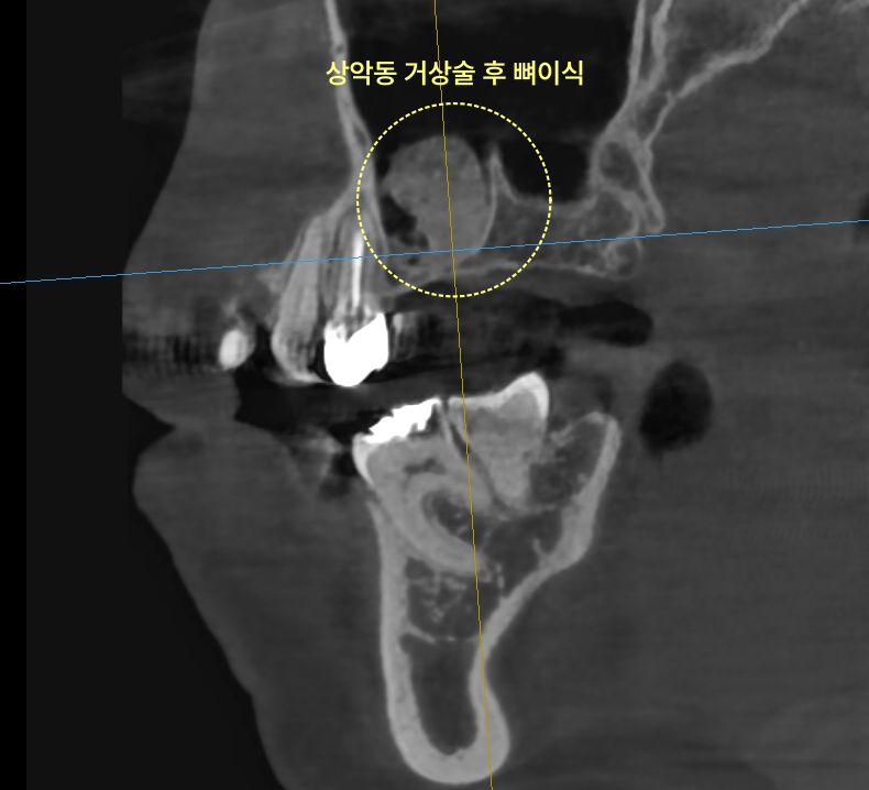 상악동 거상술 후 뼈이식이 된 CT 사진