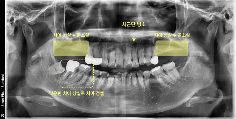 치아 상실, 골 소실, 치근단 병소, 맞은편 치아 정출이 표시된 파노라마 방사선 사진
