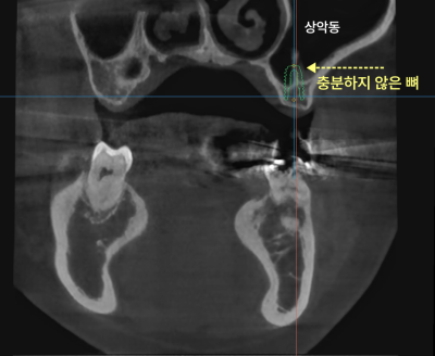 상악동 부위에 뼈가 충분하지 않음을 보여주는 CT 사진