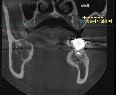 상악동 부위에 뼈가 충분하지 않음을 보여주는 CT 사진