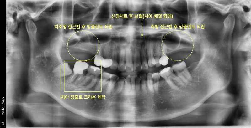 치조정 접근법, 측방 접근법 임플란트 식립 및 치아 정출 크라운 제작이 표시된 파노라마 방사선 사진
