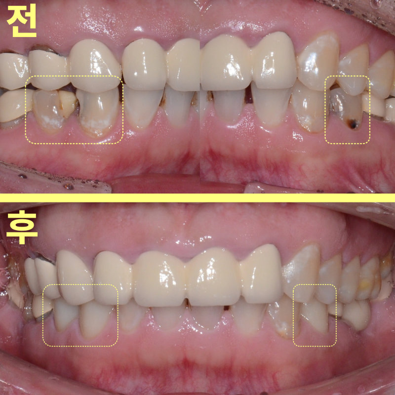 치료 전후를 비교하는 구강 내 정면 사진. 위쪽은 치료 전, 아래쪽은 치료 후의 모습으로, 충치와 변색이 개선된 앞니가 노란색 점선으로 표시되어 있음