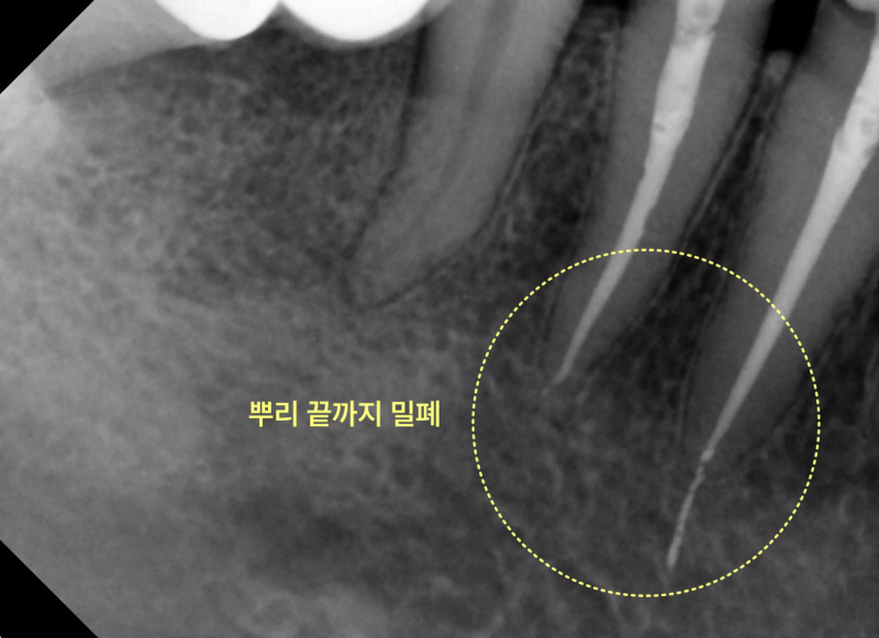 하악 어금니 부위의 치근단 방사선 사진으로, 신경관이 뿌리 끝까지 밀폐된 모습이 노란색 점선으로 표시되어 있음