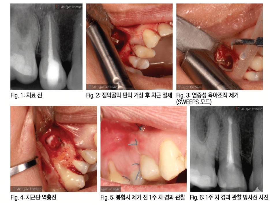 치근단 절제술의 여러 단계를 보여주는 6개의 치과 임상 사진 모음