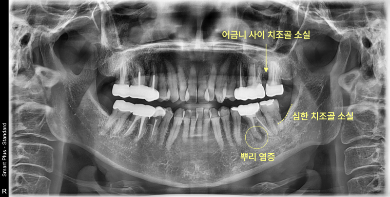치주골 소실과 뿌리 염증이 보이는 파노라마 방사선 사진