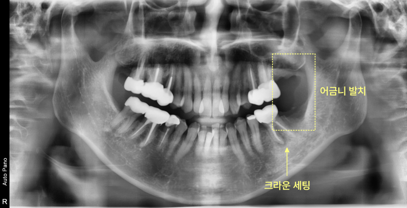 어금니 발치 및 크라운 세팅 부위를 표시한 파노라마 방사선 사진