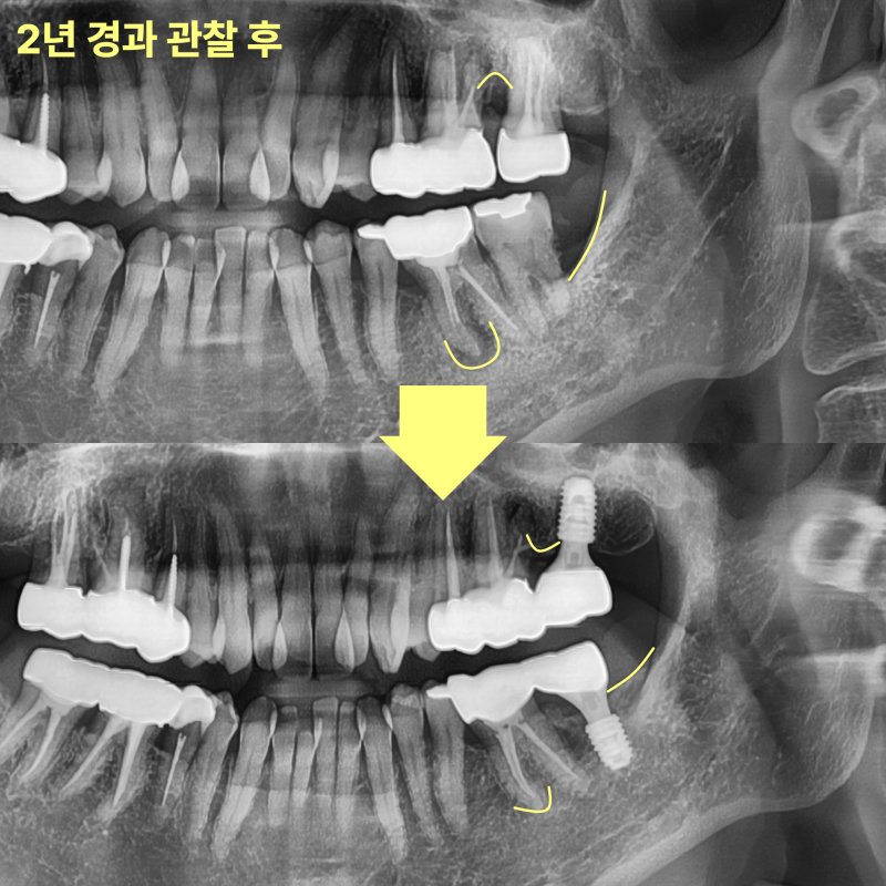 2년 경과 관찰 전후 파노라마 방사선 사진 비교